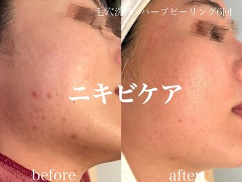 ネオリー(neorii)/毛穴洗浄＋ハーブピーリング