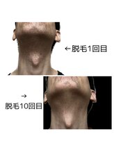 バロン/ヒゲ脱毛