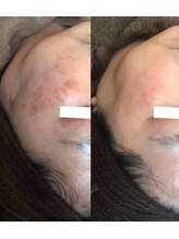 ユニクリア(Uni clear)/佐賀市│ハーブピーリング