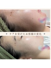 ル クラージュ(Le courage)/バクテリウムピール(20代女性)