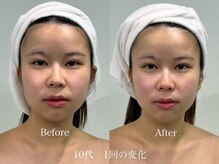 グランディールスイート(GRANDIR suite)/FACE MAKER施術結果