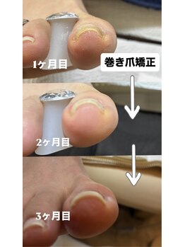 ボヌール 麻布十番店(Bonheur)の写真/もう巻き爪に悩まない！目立たず美しく整えるBonheurの巻き爪矯正で、素足に自信を。