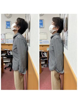 鍼灸整骨院ひで/症状改善例~猫背・巻肩~