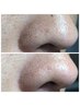 【男の毛穴洗浄 ¥4500☆】　黒くつまった毛穴/ざらざら肌を一掃 脂性肌