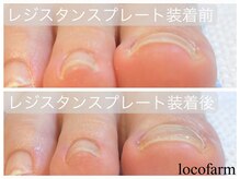 ロコ ファーム(loco farm)/巻き爪の痛みから解放