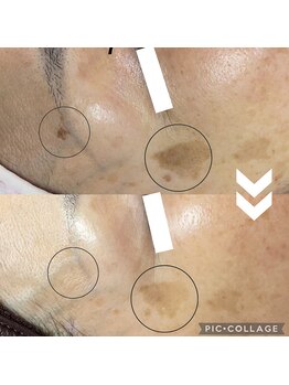 ソイ(Soi)/1回の施術でここまで改善！