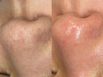 ヴィーヴ 京橋(vive)/【韓国式3D毛穴洗浄】