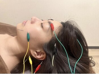 やす鍼灸院の写真/【美容鍼でむくみ×たるみケア☆】電気美容鍼で表情筋を引き上げ横顔美人♪また身体の不調にも鍼が最適!!