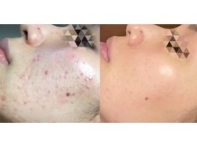 アティロン(Attirant)/【にきび、酒さ・赤ら顔】 