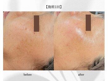 アン ビューティー(ann beauty)/施術1回【症例写真】