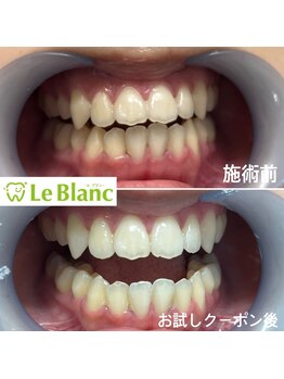 ルブラン 奈良店(Le Blanc)/回数券で歯が白くなる！？