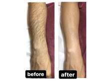 メンズ脱毛ジャパン 南小倉駅前店(メンズ脱毛JAPAN)/【Before＆After】腕脱毛