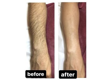 メンズ脱毛ジャパン 南小倉駅前店(メンズ脱毛JAPAN)/【Before＆After】腕脱毛