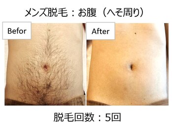 オワゾーブルー(Oiseaubleu)/【メンズ】お腹脱毛5回目