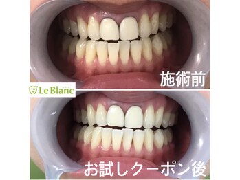 ルブラン 奈良店(Le Blanc)/歯茎も大事です!!