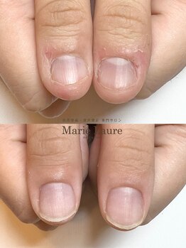 マリーロール 梅田店(Marie Laure)/自爪育成/深爪矯正/ネイルケア
