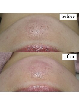 テンパ ビューティー(+10%beauty)/一撃タマゴ肌ワックス