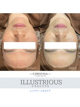 フルアナ(Hu ruana)/【シミケア】