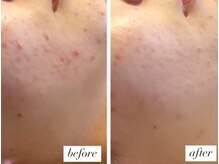 ベルーテ 田町三田(Bellute)/繰り返す肌荒れにはハーブ！