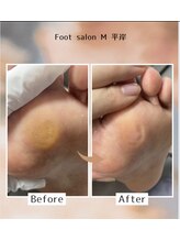 エム 平岸(M)/【魚の目/タコ】30代女性