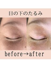 ハリマル(HARIMARU)/目の下のたるみ、黒クマ