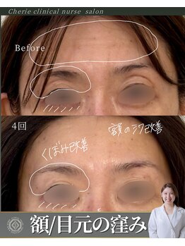 シェリー(Cherie)/目周りたるみ/窪み/額シワ/乾燥