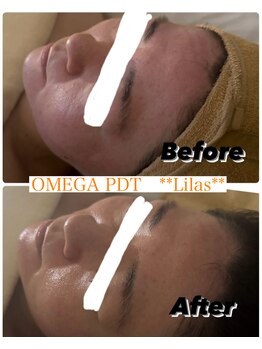 リラ(Lilas)/赤み肌には黄色の光