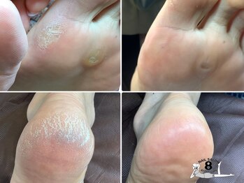 ネイルエイト 新百合ヶ丘(nail8)の写真/素足の季節に向けて。お出かけ前の角質ケアで自信の持てる足元に…♪