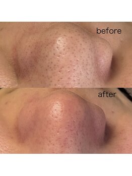 シューティングハーツ(SHOOTING HEARTS)/毛穴ケア（40代女性）