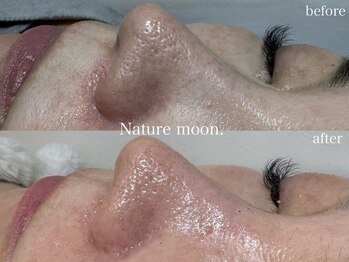 ナチュールムーン(Nature moon.)/毛穴洗浄