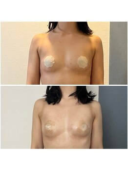 モア(moa)/バストボリューム　3回での変化