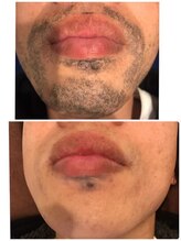 ナナラ(nanala)/脱毛器エピアスの効果