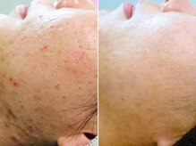 ハダイ(HADAY)/ニキビ改善｜ハーブピーリング