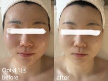 フォー(For...)/高密度超音波Optyl◇赤み/保湿