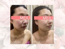 神門整体院 甲東園/REVIハーブピーリングB→A