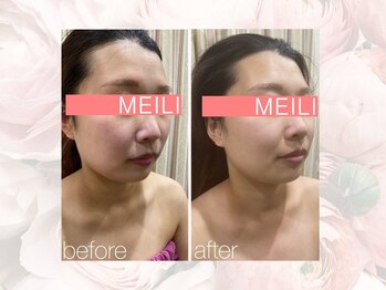 神門整体院 甲東園/REVIハーブピーリングB→A