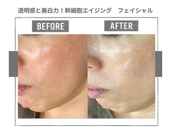 ラ ルーチェ 星田/幹細胞エイジング　フェイシャル
