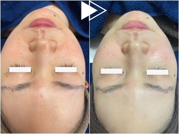 リコ(Ricco)/赤み毛穴ハーブ★¥9990