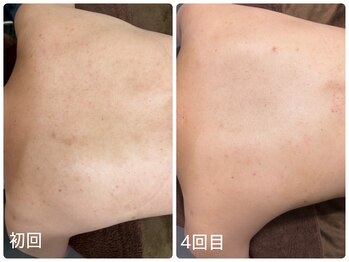 ケー(K)/繰り返しできる背中ニキビに