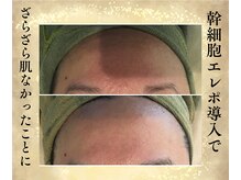 サンテボーテ(Sante Beaute)/幹細胞エレクとポレーション