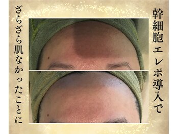 サンテボーテ(Sante Beaute)/幹細胞エレクとポレーション