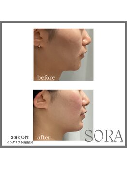 青空 天神大名店(SORA)/オンダリフト1回60kj