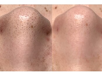 ルイス(LOUIS)の写真/黒ずみ・開き毛穴改善◎韓国式毛穴洗浄でつるんたまご肌へ