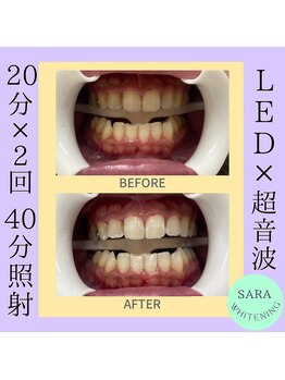 ココティ ホワイトニング(Cocotii)/お客様ビフォーアフター