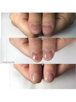 ネイル アンチュ(Nail Anchu)の写真/コンプレックス爪、トラブル爪、深爪などありとあらゆる爪のお悩みを解消します♪なんでもご相談下さい！