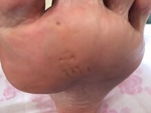 ビサンテ サロン/難い魚の目・鶏眼も御任せあれ！