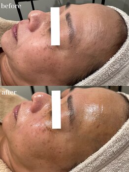 インク(ink)/スノーピール1回での効果！