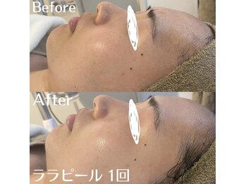 ホワイトアクア 中目黒店(WHITE AQUA)/ハーブピーリング 毛穴・黒ずみ