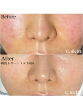 シースキン 盛岡駅前店(c.skin)/お客様ビフォーアフター