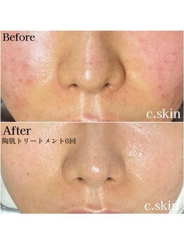 シースキン 盛岡駅前店(c.skin)/お客様ビフォーアフター